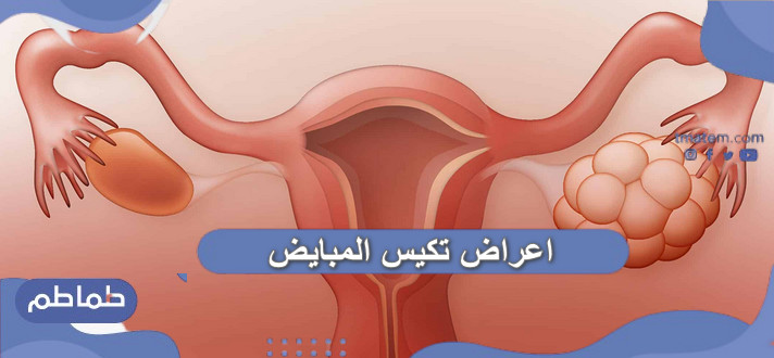 اعراض تكيس المبايض .. كيف أعرف أن عندي تكيسات على المبايض