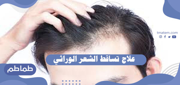 علاج تساقط الشعر الوراثي