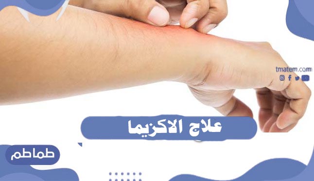 علاج الاكزيما